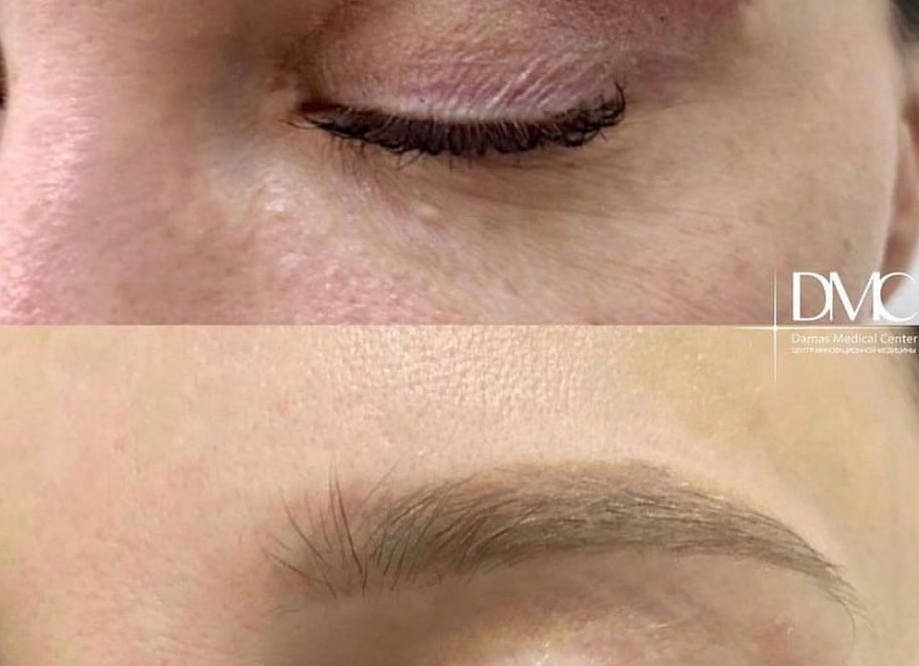 Лазерное удаление шрамов после пластической операции