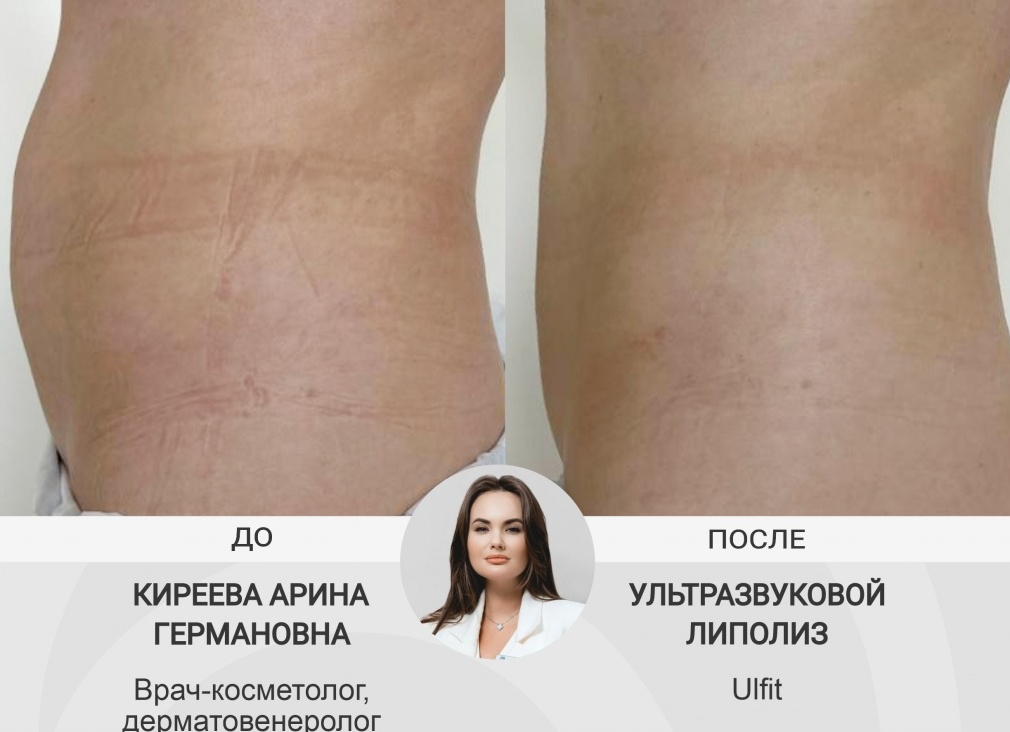 Что такое ультразвуковой липолиз и как он работает?