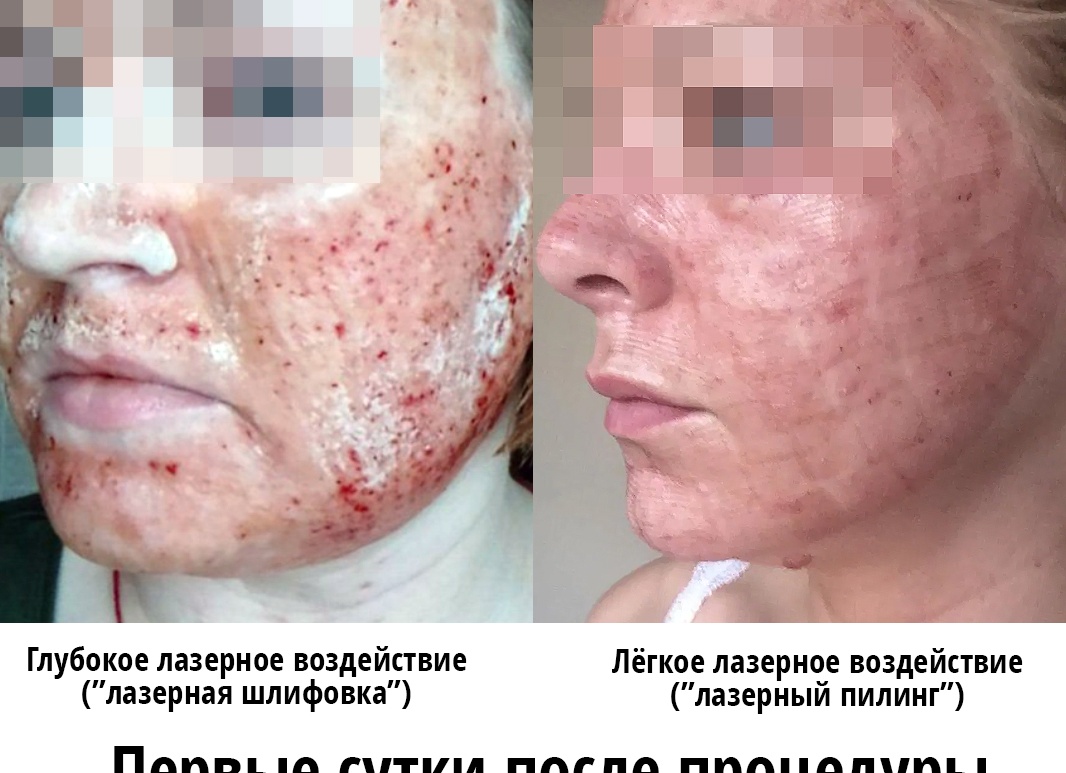 Лазерная шлифовка лица - что это и как проводить