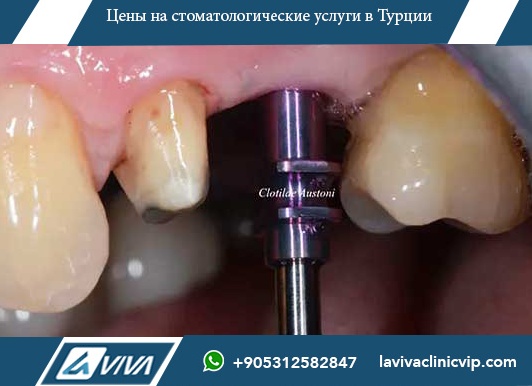 Приятно познакомиться - импланты!