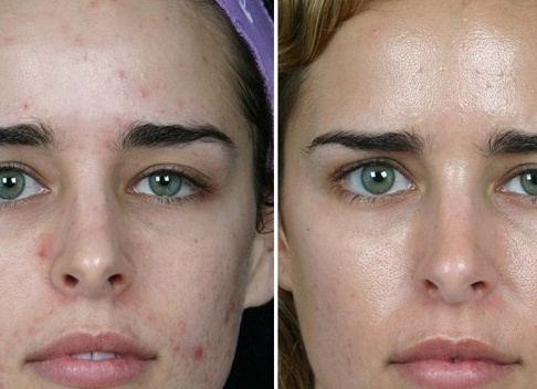 Ультразвуковой пилинг - польза или вред