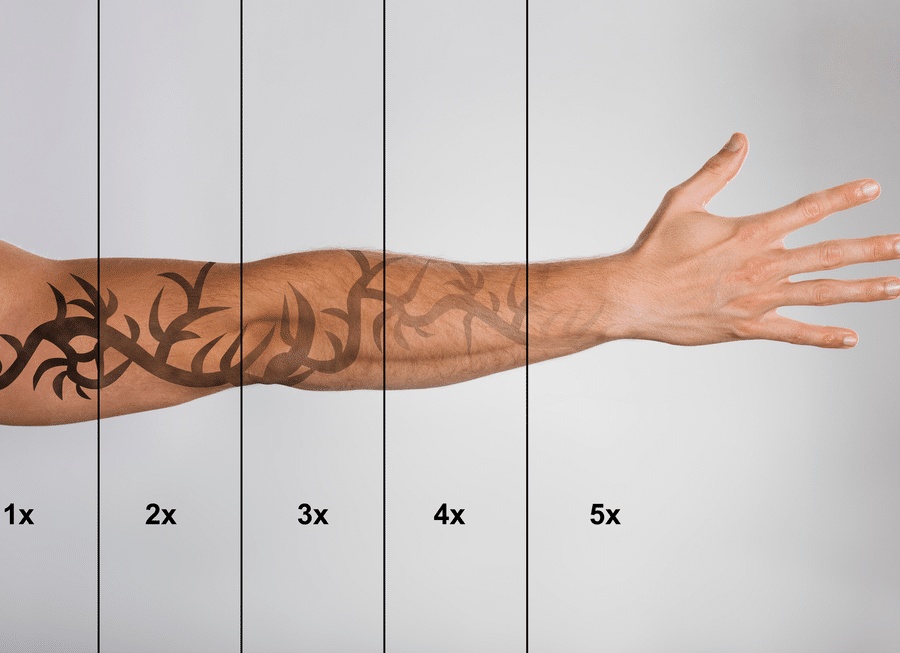 Что влияет на возможность лазерного удаления шрамов