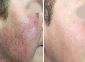 Можно ли делать пилинг при куперозе