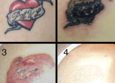 Пикосекундный лазер для удаления татуировок — отзывы, принцип работы