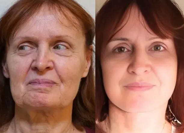 Фейслифтинг омолаживает других и молодеет сам!