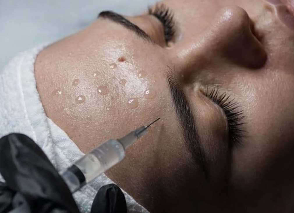 Безинъекционные омолаживающие процедуры: топ-5