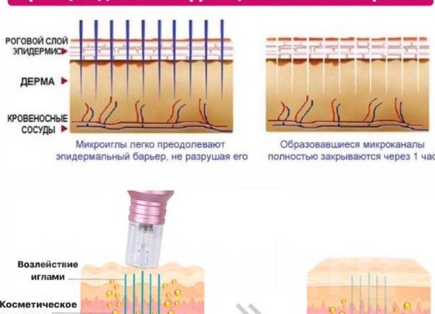 Принцип действия фракционной мезотерапии