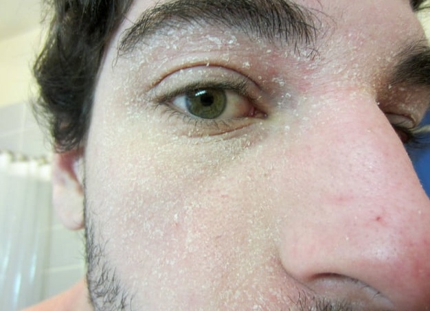 Как бороться с шелушащейся кожей - советы косметолога