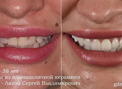 Хочу красивую улыбку: что важнее красивые губы или здоровые зубы?