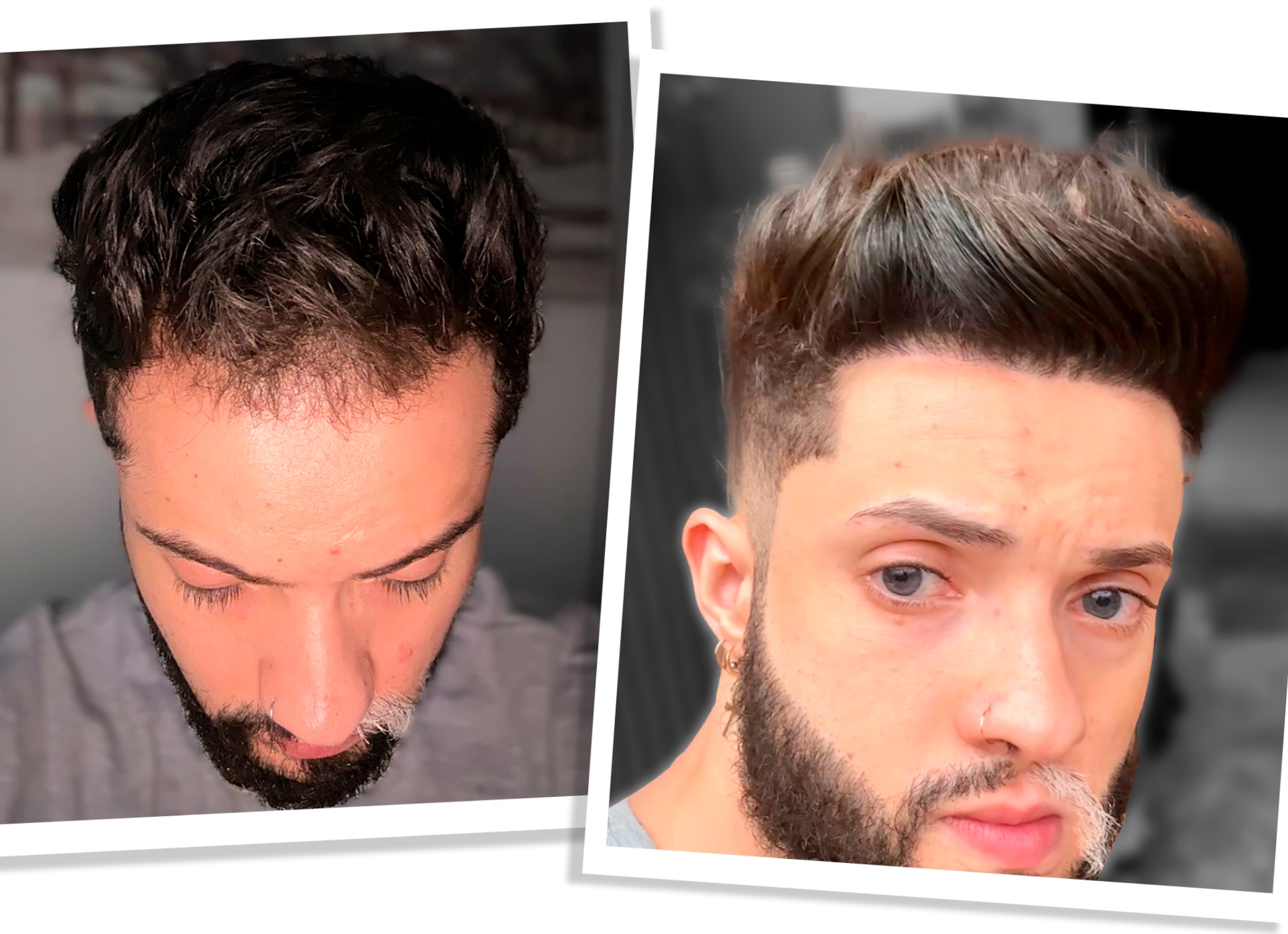 Методы избавления от нежелательных волос на теле