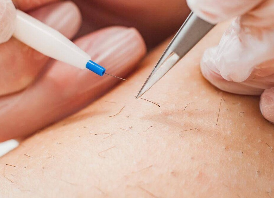 Как проходит электроэпиляция и какое оборудование для этого необходимо