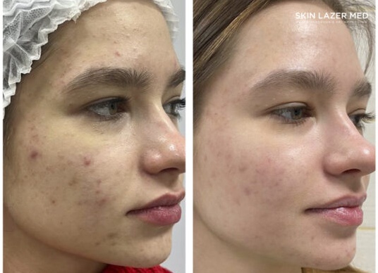 Лучшие процедуры против акне