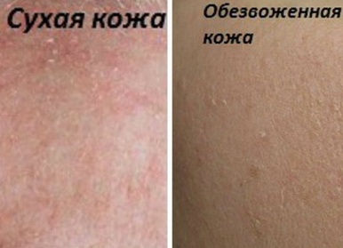 В чем отличия сухой и обезвоженной кожи