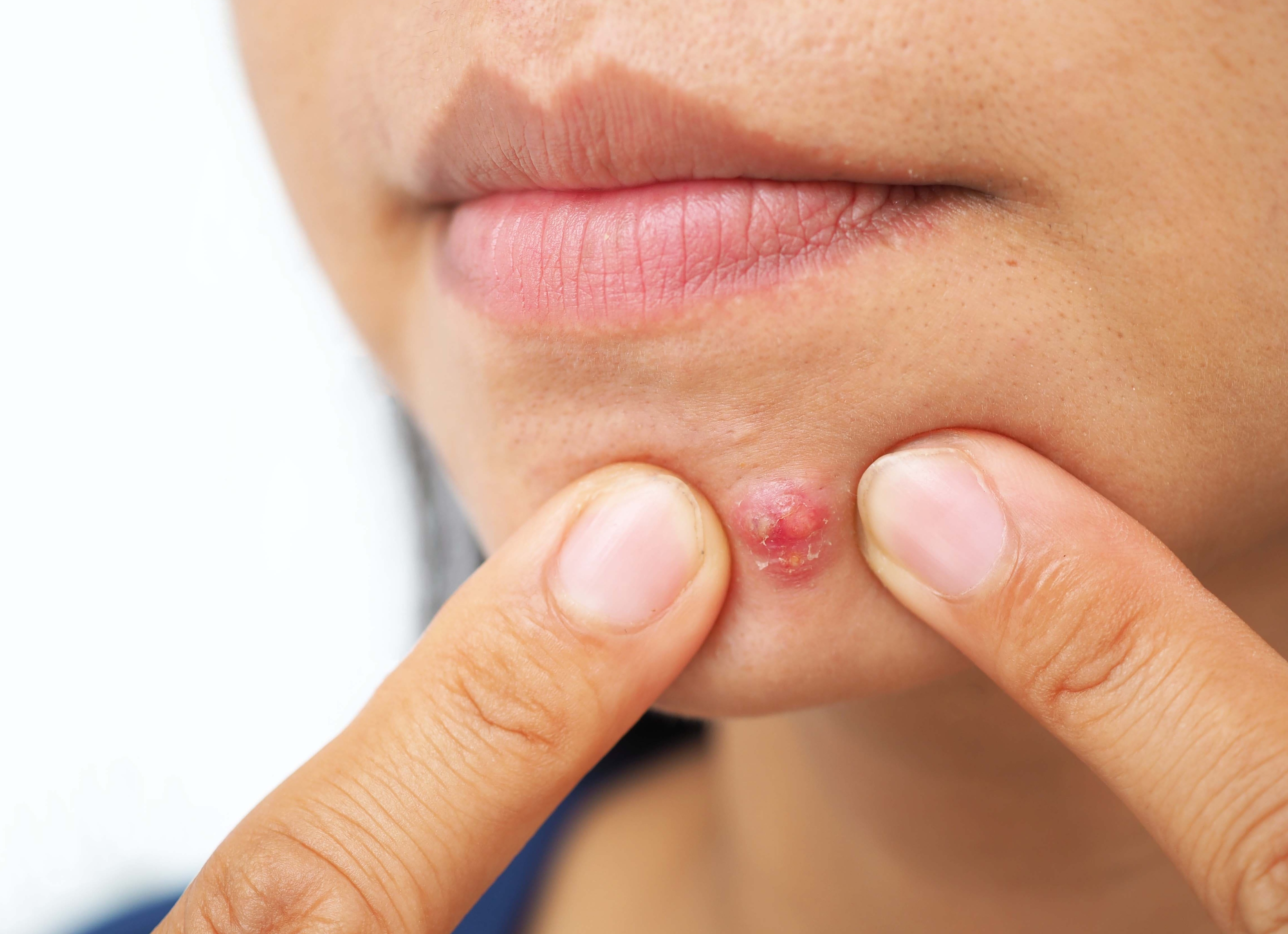 Угревая сыпь на лице, причины появления у женщин