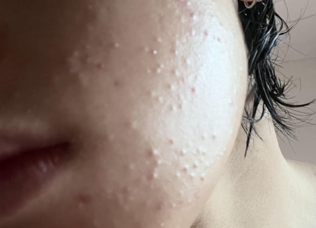 Что такое комедоны и как с ними бороться