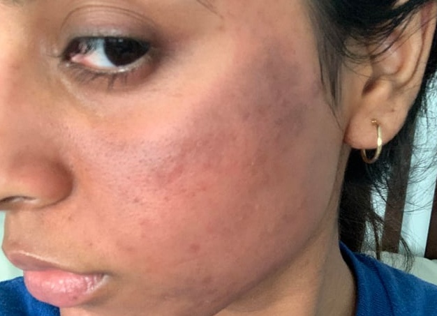 Последствия после пилинга