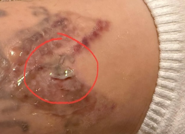 Лазерное удаление рубцов после травм