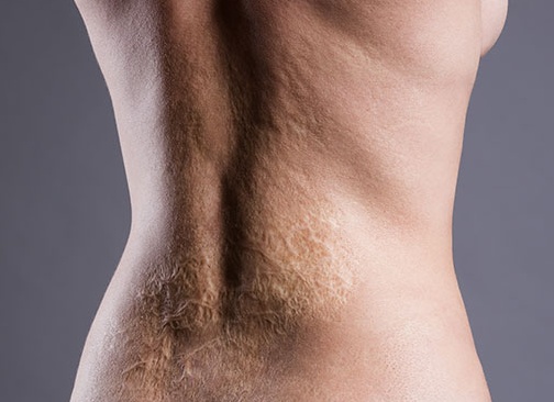 Избавление от послеожоговых рубцов с помощью лазера