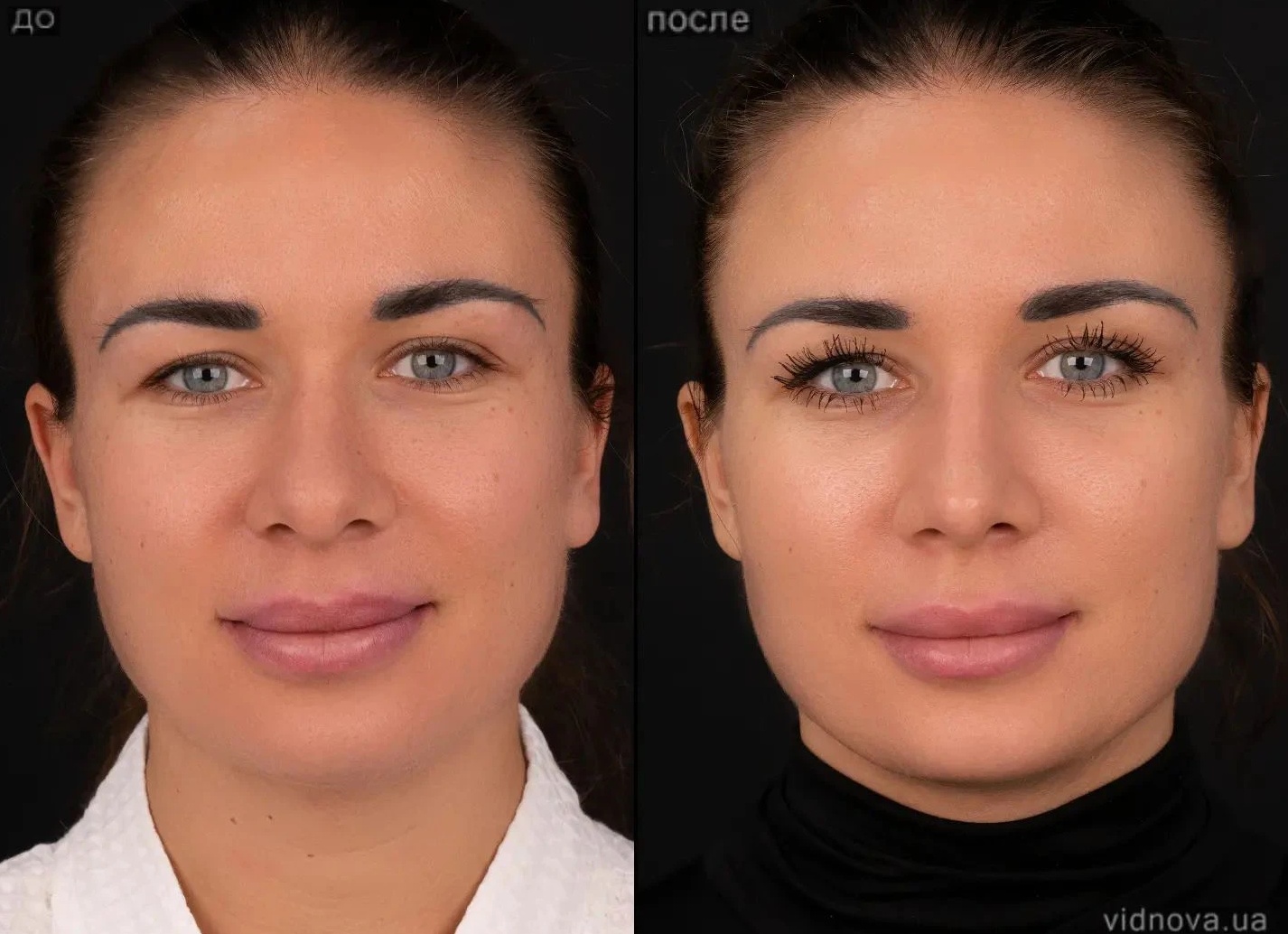 Ринопластика. Результаты ДО/ПОСЛЕ