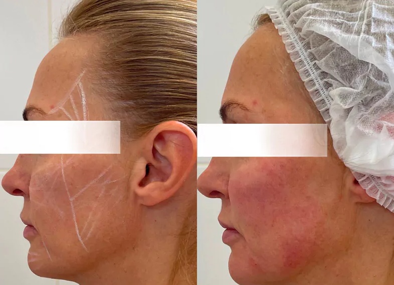 Подтяжка лица нитями - что это