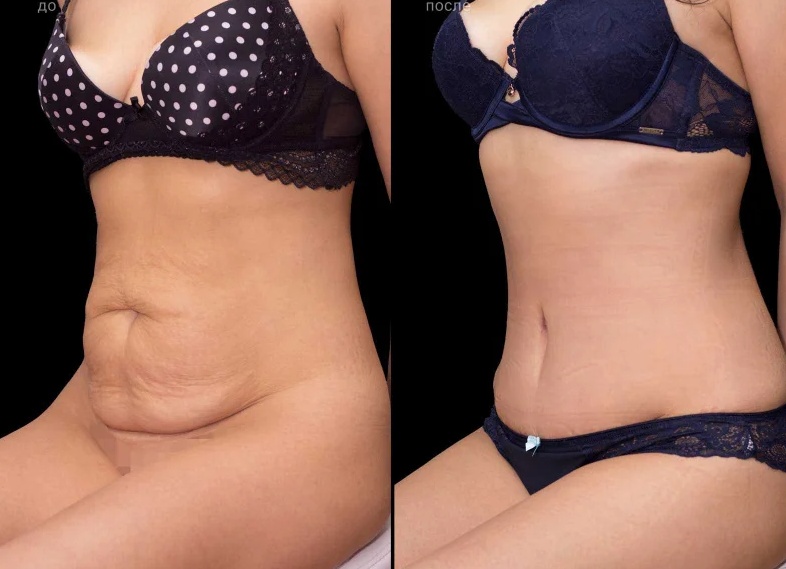 Липолитик Aqualyx: отзывы, инструкция по применению