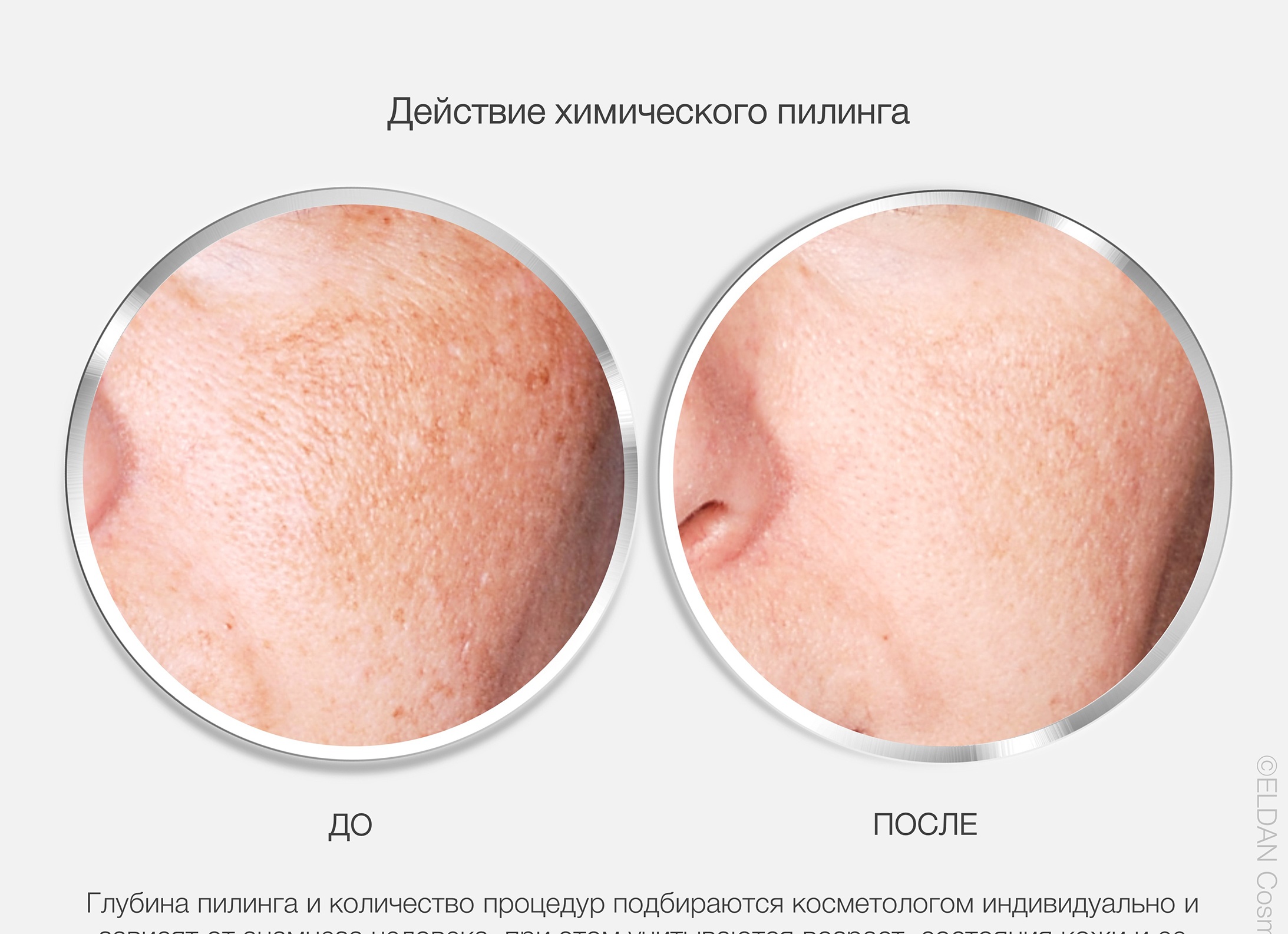 Химический пилинг для лица - польза и опасность