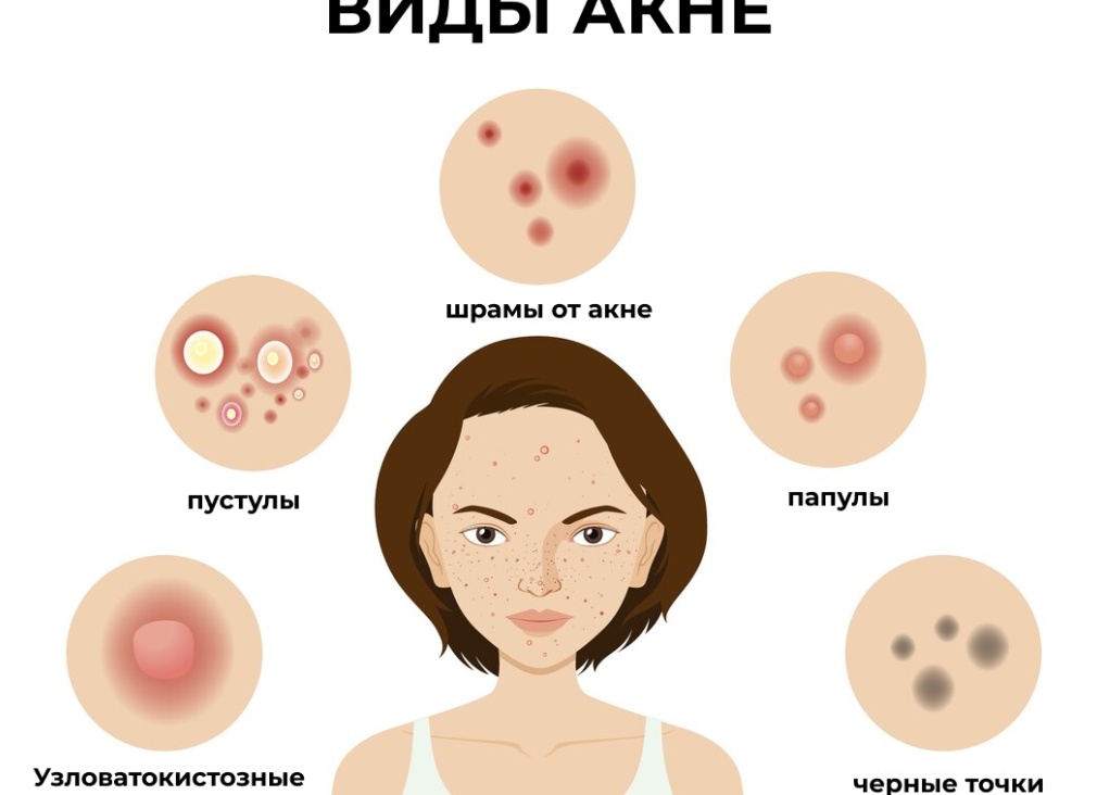 Как бороться с угревой сыпью у косметолога