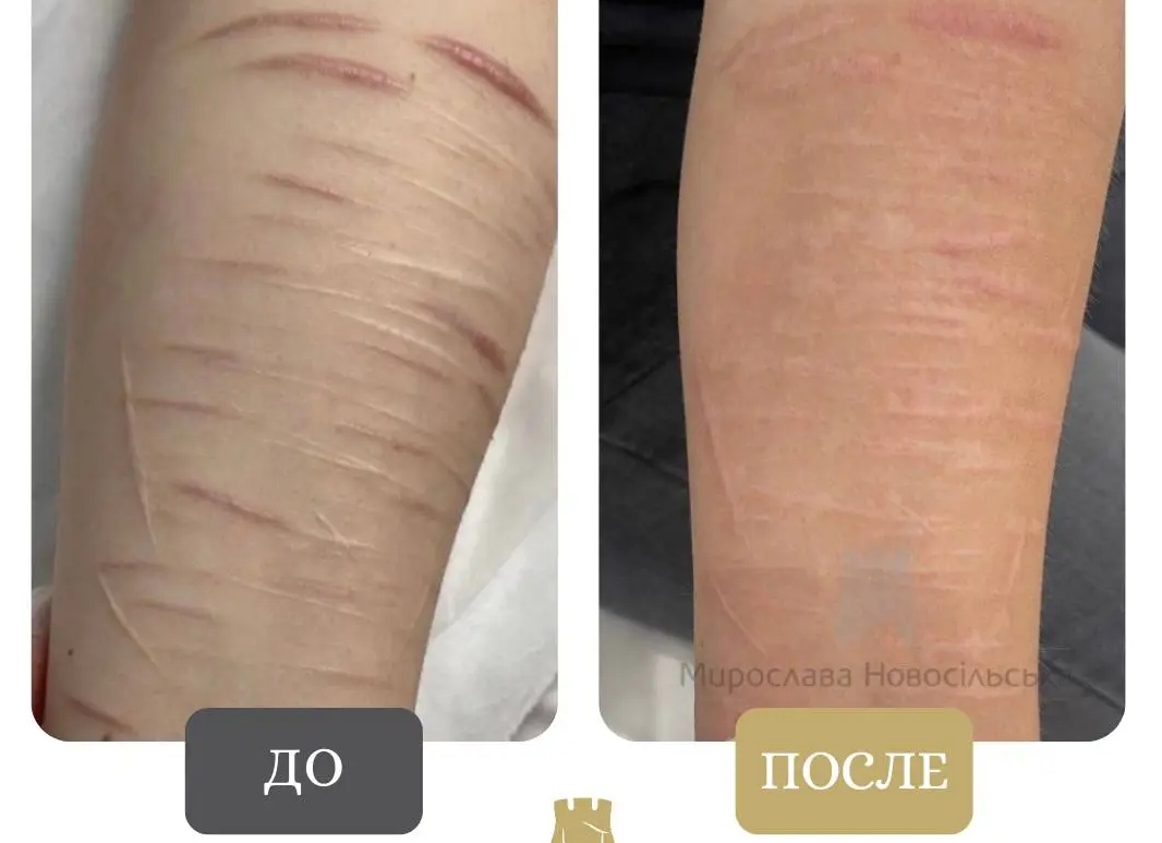 Когда можно начинать лечение шрамов лазером