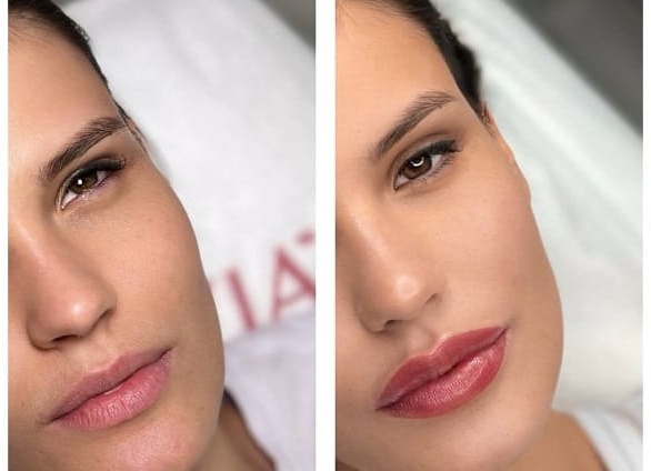 Увеличение губ - чем делают?