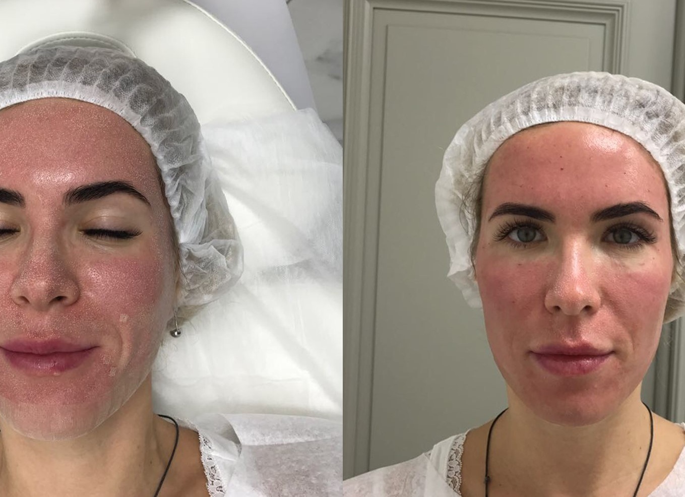 Лазерное омоложение лица: что это и как работает?