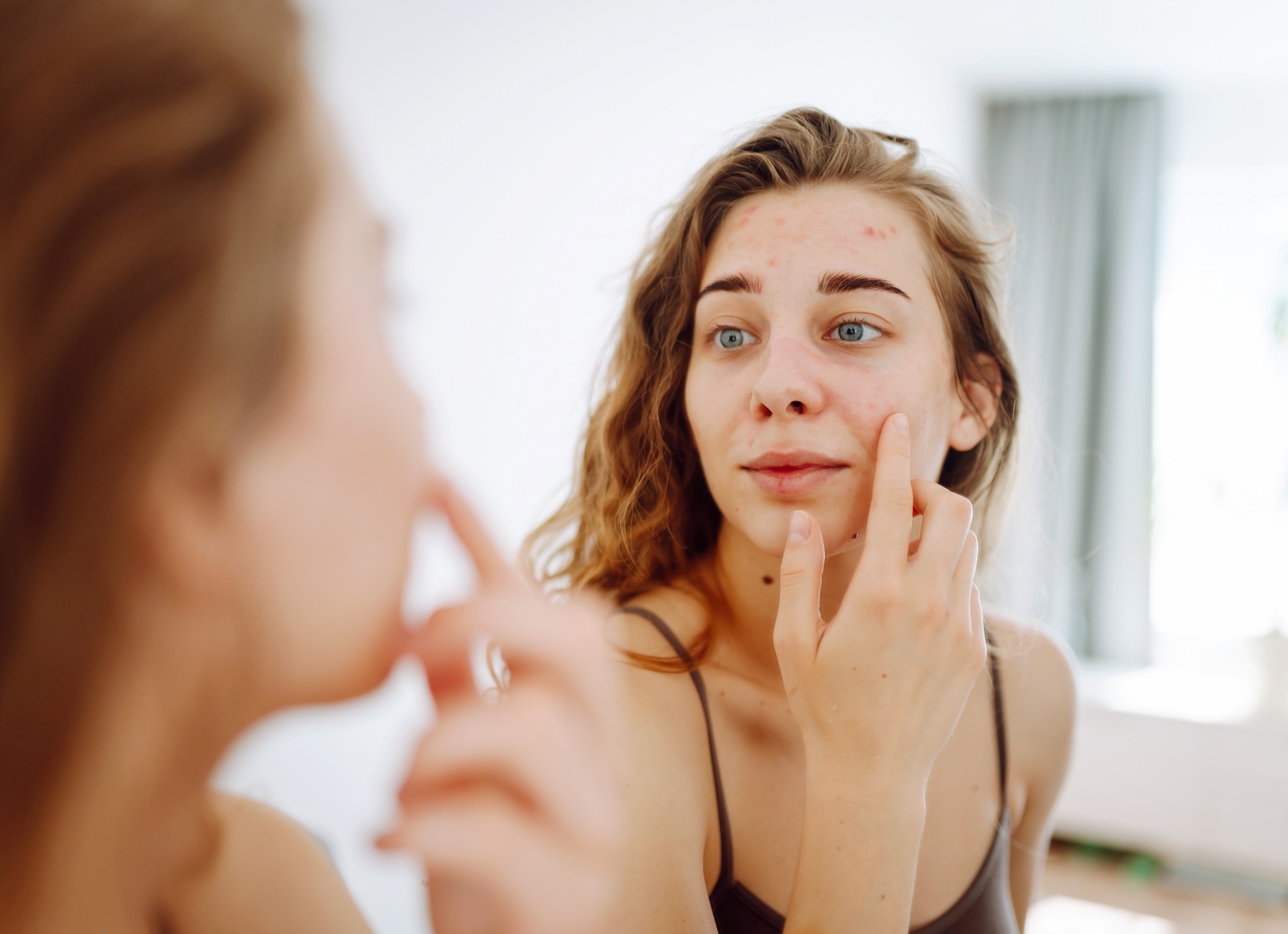 Прыщи от сладкого — почему появляются, как их вылечить