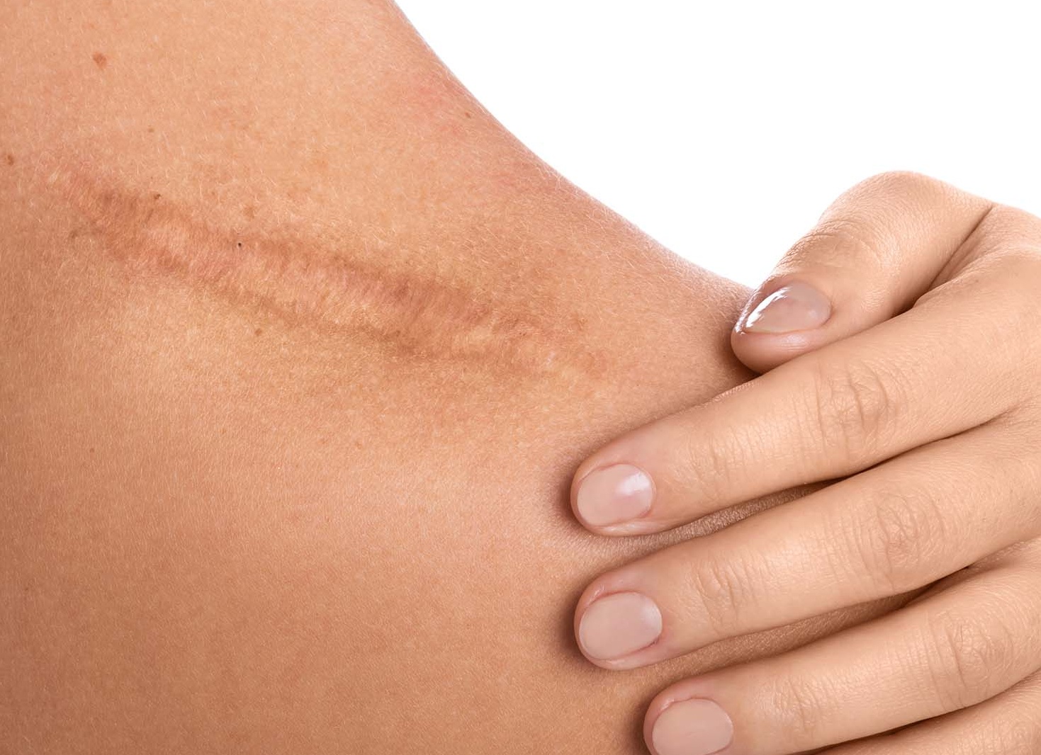 Какие виды рубцов поддаются лазерному лечению