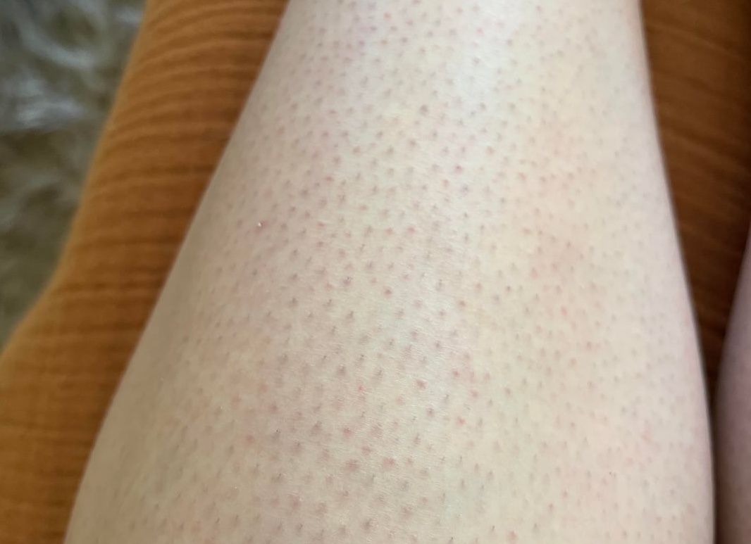 Горячий воск — главный помощник при депилировании