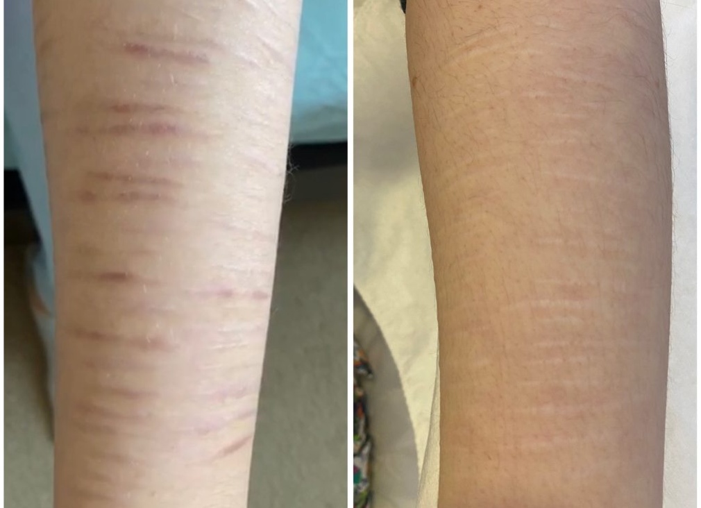 Можно ли удалять лазером рубцы и шрамы у детей