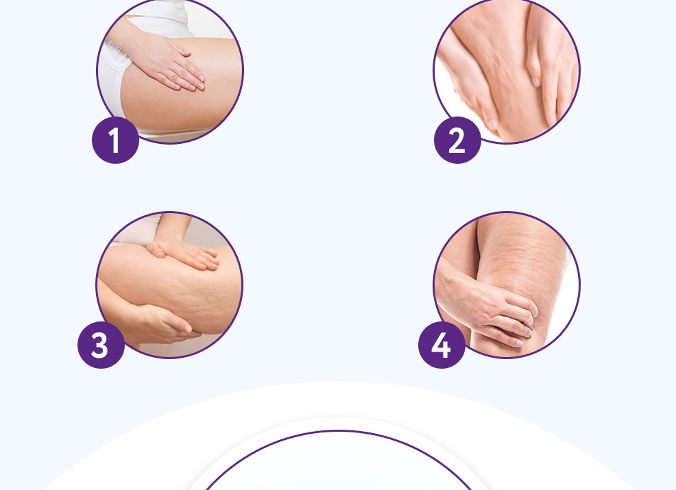 Как избавиться от целлюлита быстро и эффективно