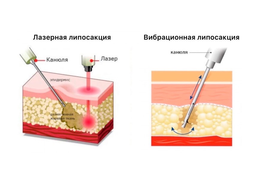 Ультразвуковая липосакция Vaser: когда и как проводится, в чем отличия от других методов липосакции