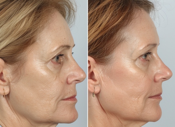 Карбокситерапия - чудо-процедура от морщин и целлюлита