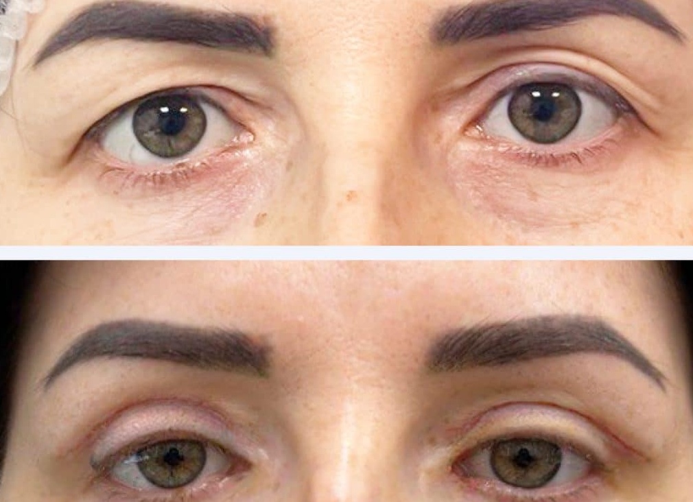 5 вопросов о реабилитации после блефаропластики. Отвечает пластический хирург Атаманов Д.К