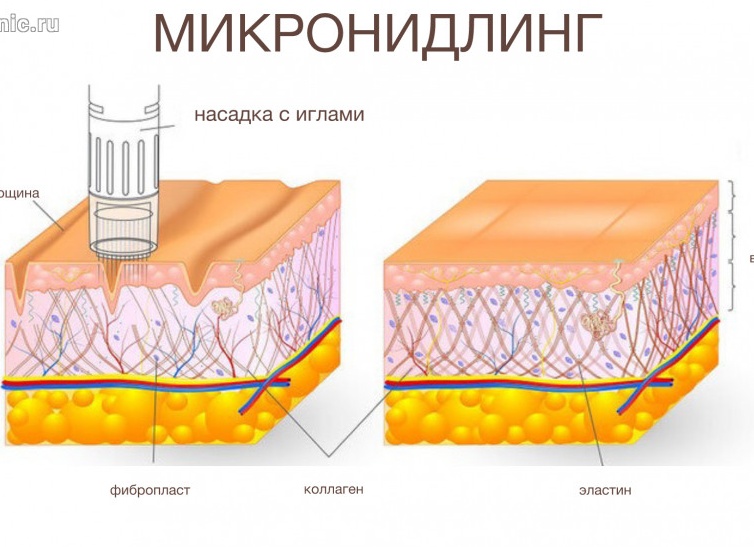 Фракционная микроигольчатая мезотерапия - что это