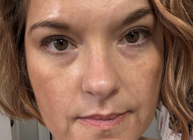 Азелаиновый пилинг - здоровая и красивая кожа