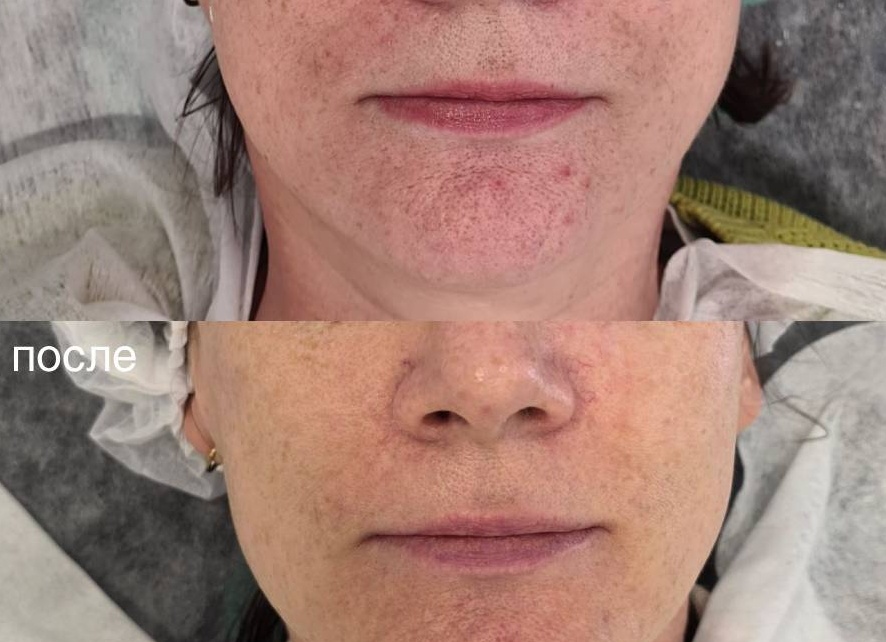 Кому показана фототерапия