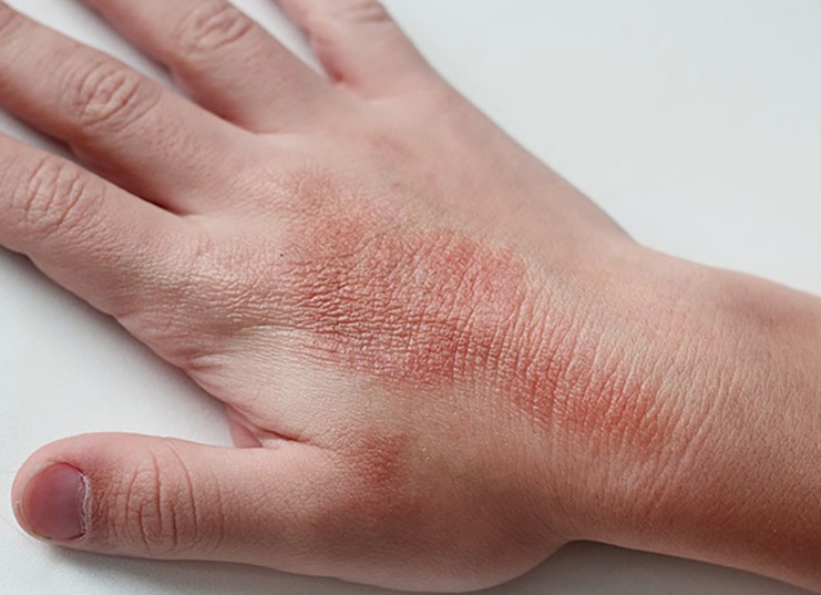 Пигментация на руках: причины и методы удаления