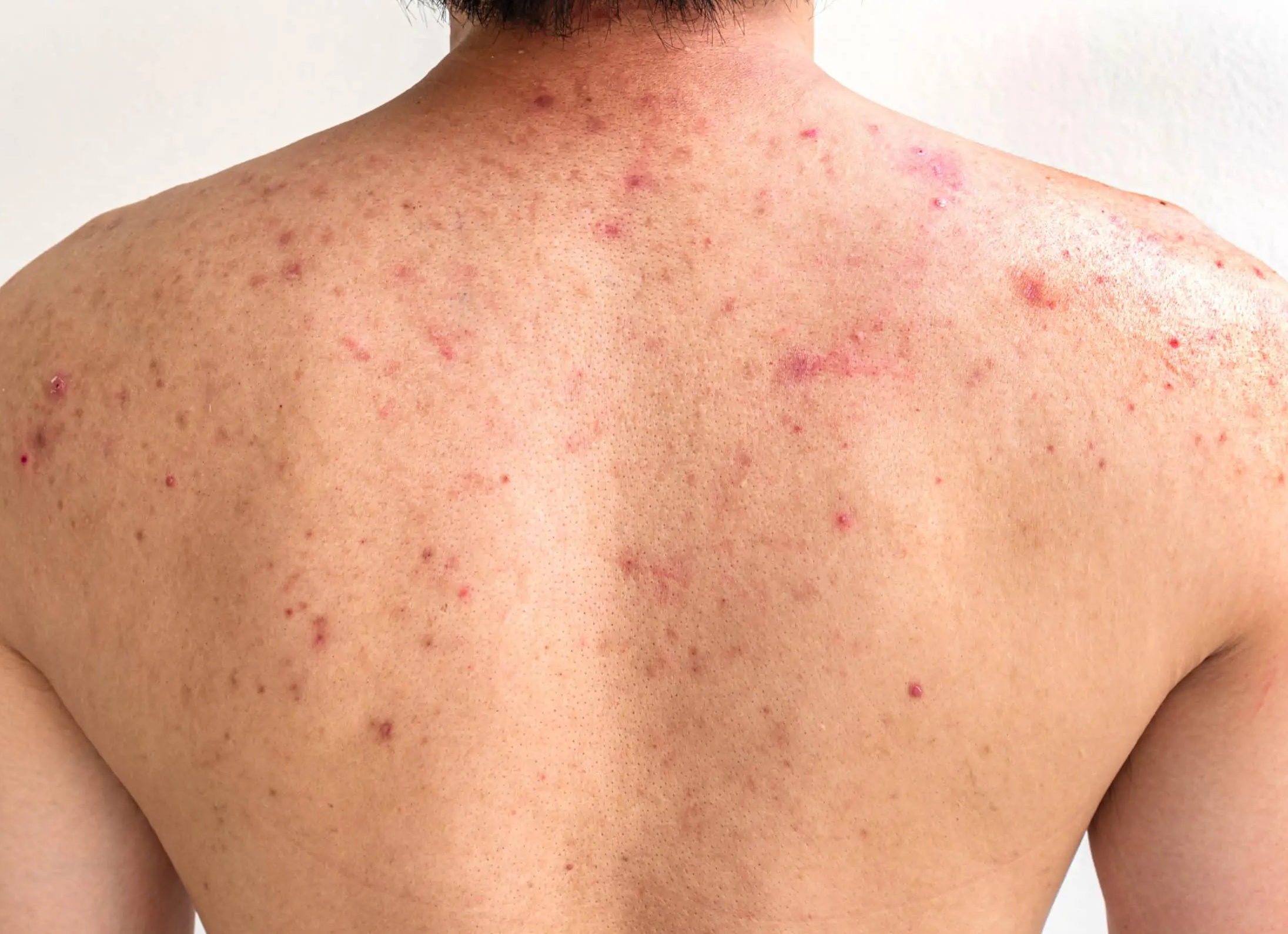 Акне на взрослой коже - причины появления, особенности лечения, процедуры