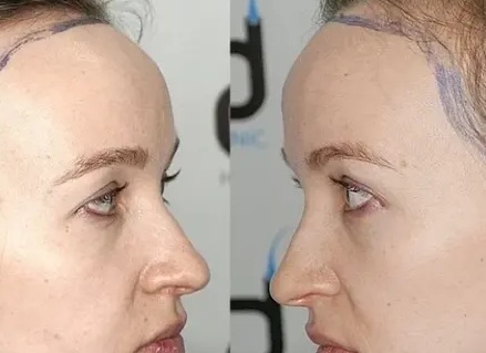 Мезотерапия для мужчин: эффективное решение проблемы выпадения волос