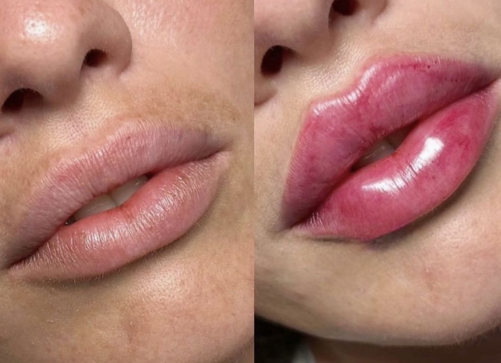 Почему ботулинотерапия, биоревитализация и нитевой лифтинг — это идеальное сочетание для омоложения