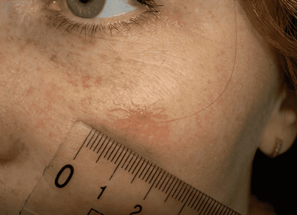 Удаление сосудистых звездочек на лице: мифы и реальность