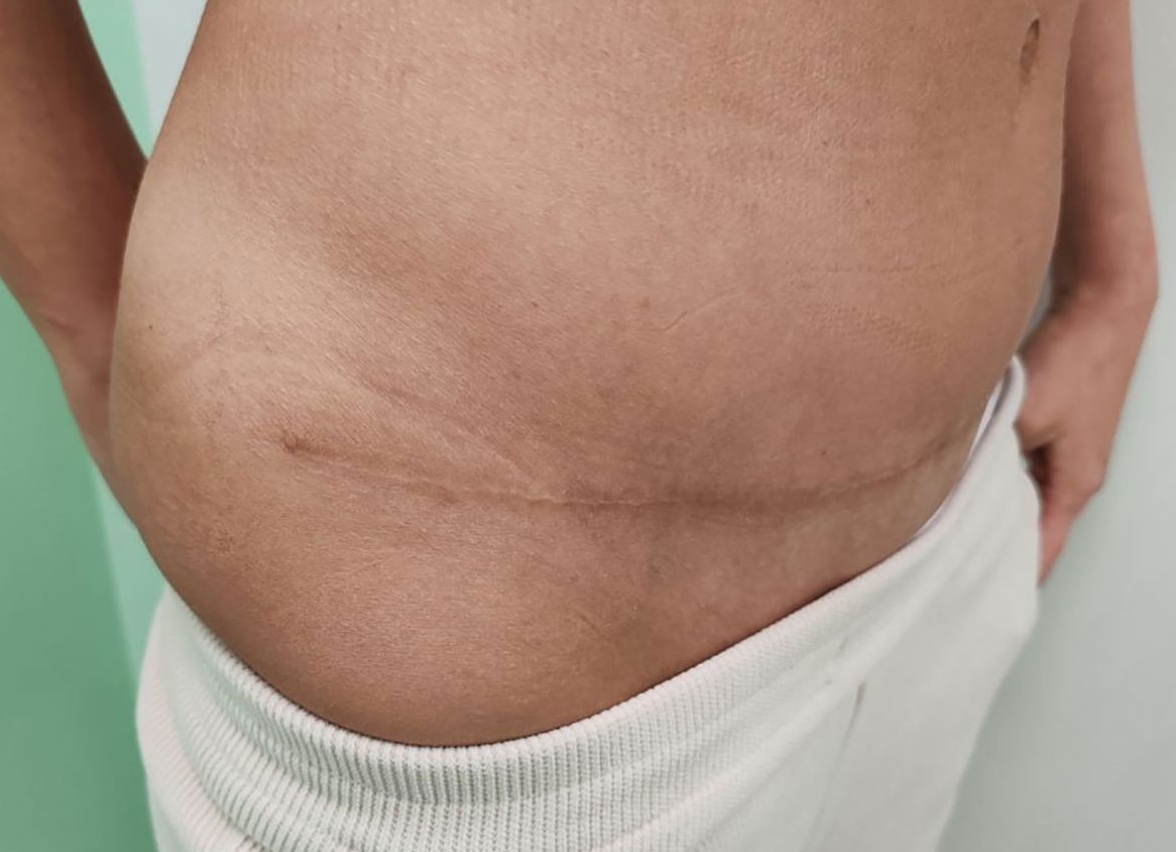 Как убрать рубцы после маммопластики: советы и методы