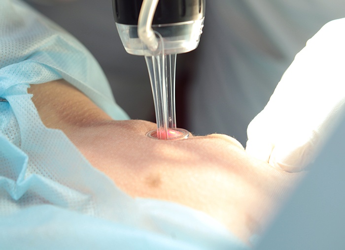 Отбеливание интимной зоны — как проходит и какие методы самые эффективные